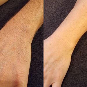 Laser hair removal results on the arm