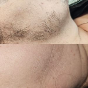 Before and after facial laser hair removal treatment