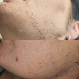 Before and after laser hair removal on the side of the face