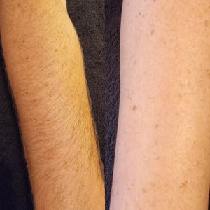 Before and after upper-arm laser hair removal